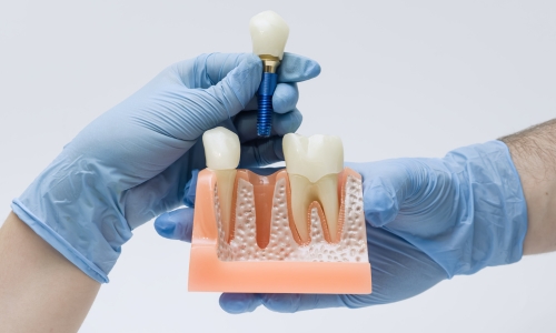 Dental Crowns at Dentistry in Oak Ridges